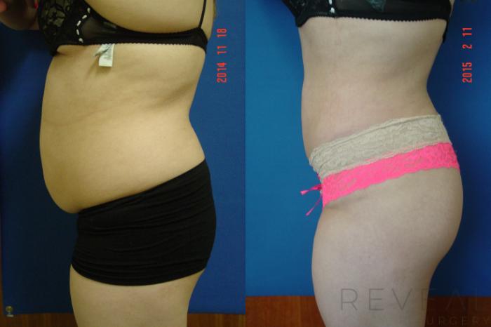 Before & After Brazilian Butt Lift Case 170 View #4 View in San Jose, CA
