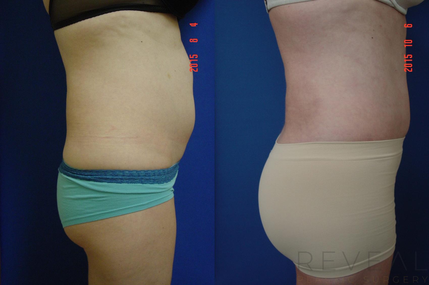 Before & After Brazilian Butt Lift Case 181 View #1 View in San Jose, CA