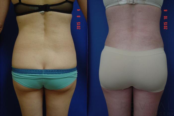 Before & After Brazilian Butt Lift Case 181 View #4 View in San Jose, CA