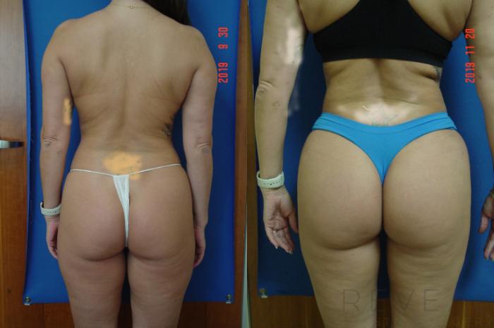 Before & After Brazilian Butt Lift Case 375 View #1 View in San Jose, CA