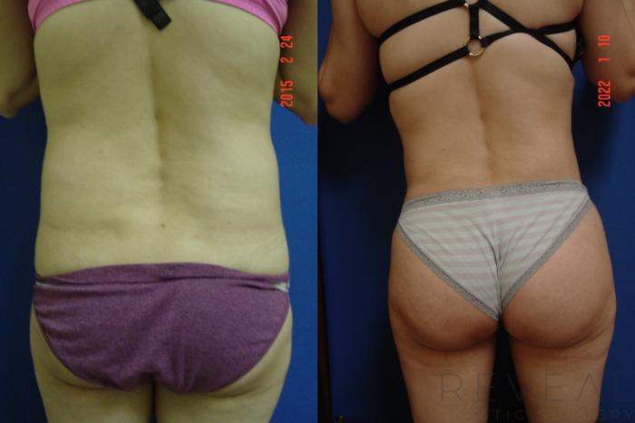 Before & After Mommy Makeover Case 599 Back View in San Jose, CA