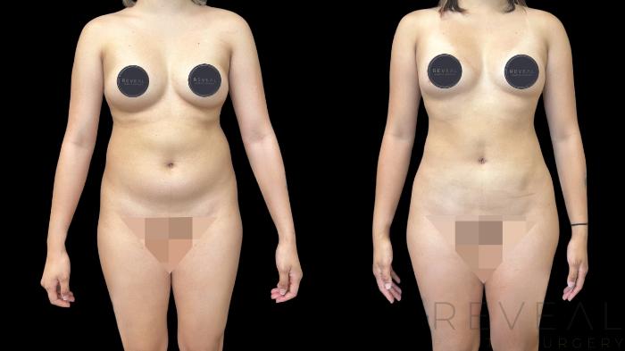Before & After Liposuction Case 779 Front View in San Jose, CA