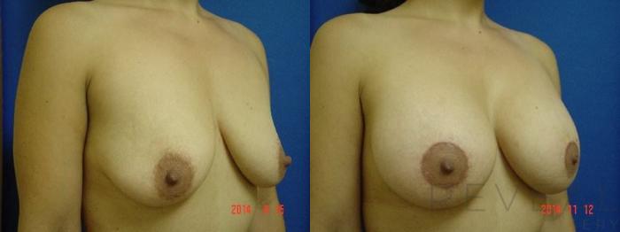 Before & After Breast Augmentation Case 160 View #3 View in San Jose, CA