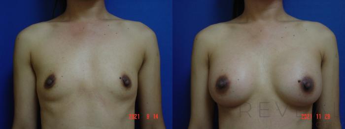 Before & After Breast Augmentation Case 596 Front View in San Jose, CA