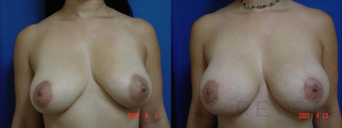 Before & After Breast Reconstruction Case 684 Front View in San Jose, CA