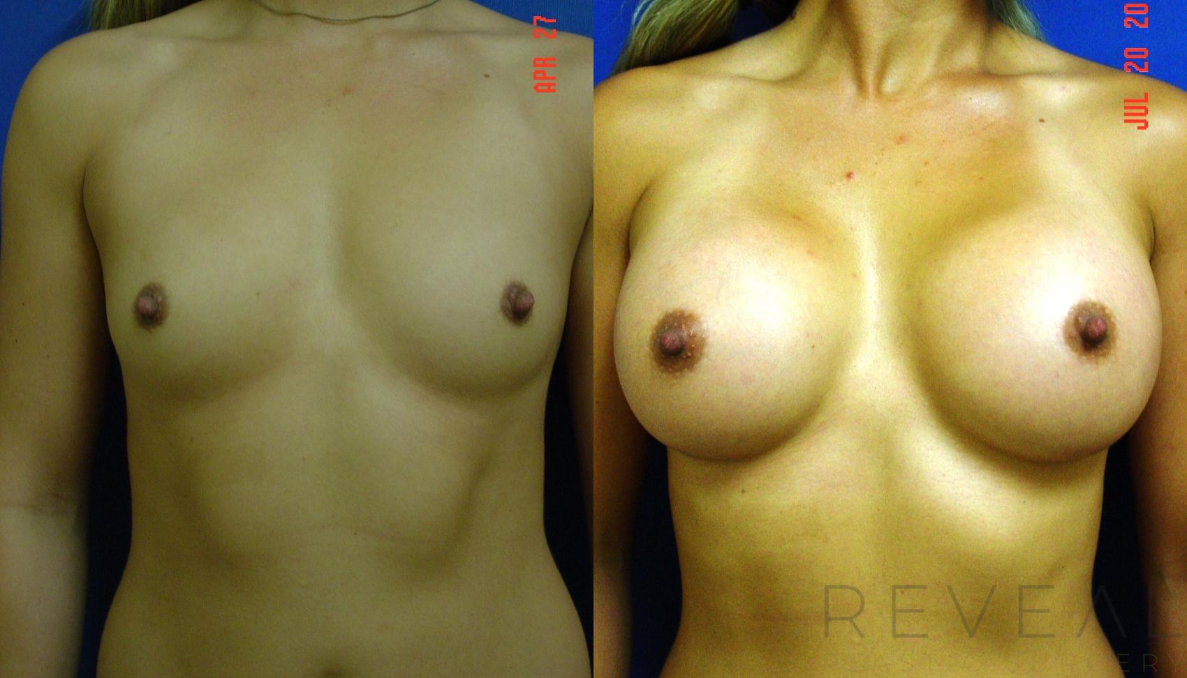 Before & After Breast Augmentation Case 77 View #1 View in San Jose, CA