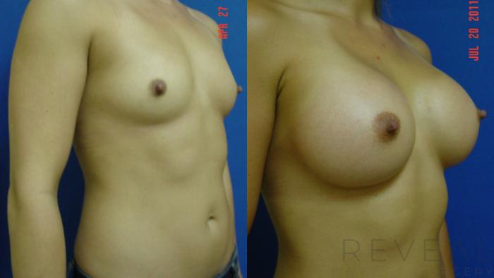 Before & After Breast Augmentation Case 77 View #2 View in San Jose, CA