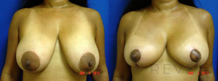 Before & After Breast Reduction Case 103 View #1 View in San Jose, CA