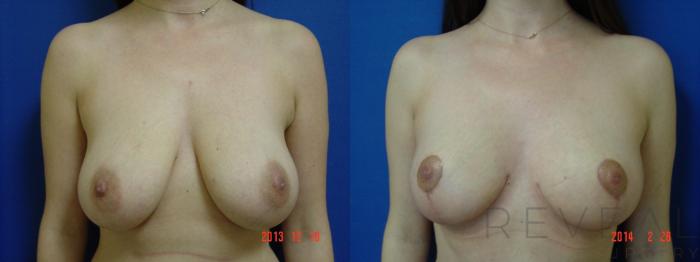 Before & After Breast Reduction Case 133 View #1 View in San Jose, CA