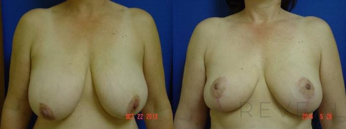 Before & After Breast Reduction Case 143 View #1 View in San Jose, CA