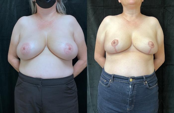 Before & After Breast Reduction Case 699 Front View in San Jose, CA