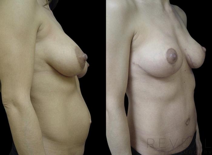 Before & After Breast Reduction Case 719 Front View in San Jose, CA