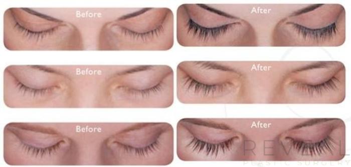 Before & After LATISSE® Eyelash Enhancement Case 30 View #1 View in San Jose, CA
