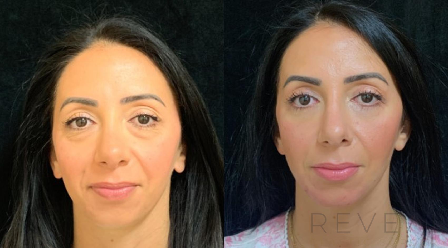 Before & After Chin Augmentation Case 578 View #1 View in San Jose, CA