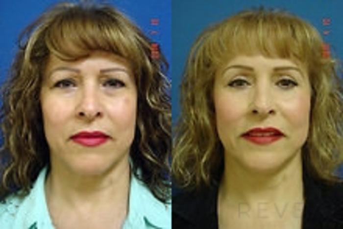 Before & After Neck Lift Case 176 View #1 View in San Jose, CA