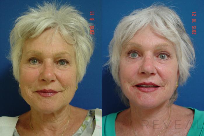 Before & After Neck Lift Case 182 View #1 View in San Jose, CA