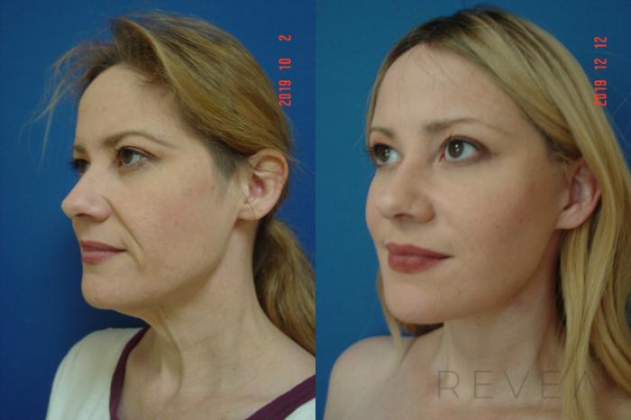 Before & After Neck Lift Case 381 View #1 View in San Jose, CA