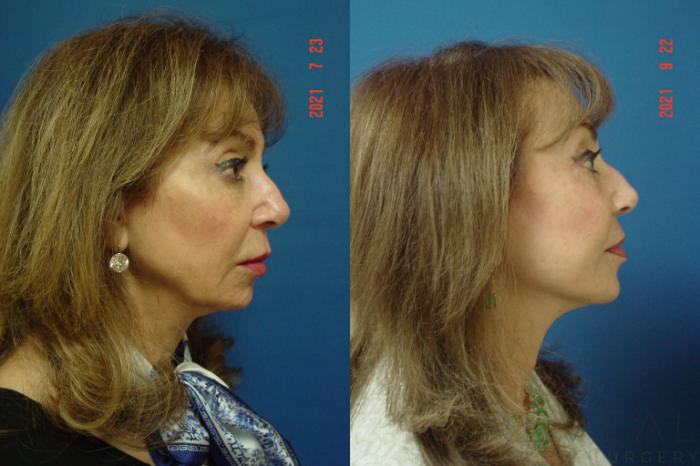Before & After Neck Lift Case 587 View #1 View in San Jose, CA