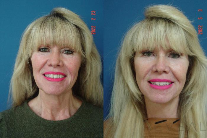 Before & After Neck Lift Case 636 Front View in San Jose, CA