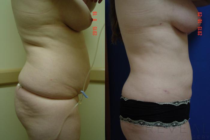 Before & After Liposuction Case 183 View #2 View in San Jose, CA