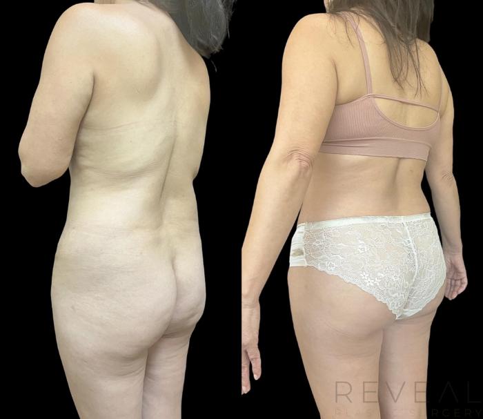 Before & After Brazilian Butt Lift Case 709 Front View in San Jose, CA