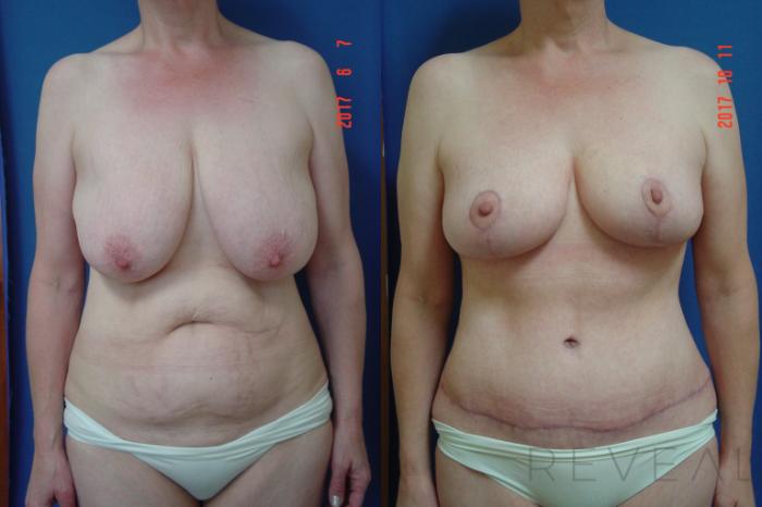 Before & After Breast Reduction Case 232 View #1 View in San Jose, CA