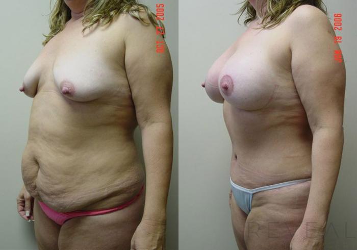 Before & After Breast Augmentation Case 3 View #2 View in San Jose, CA
