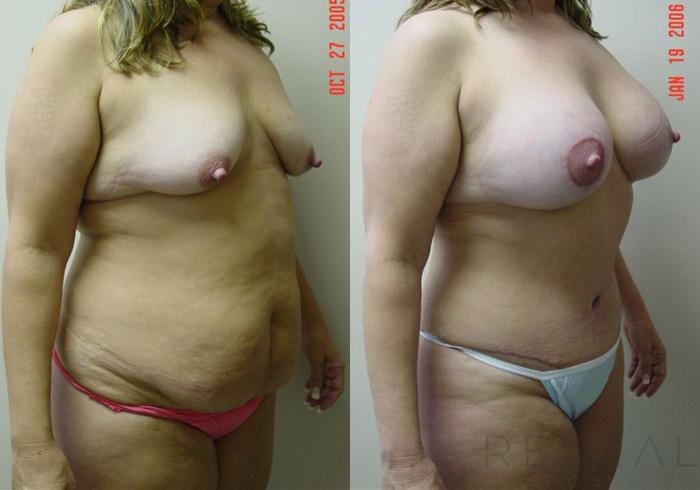 Before & After Breast Augmentation Case 3 View #3 View in San Jose, CA
