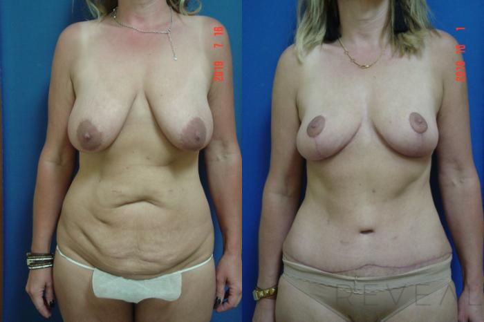 Before & After Tummy Tuck Case 365 View #1 View in San Jose, CA
