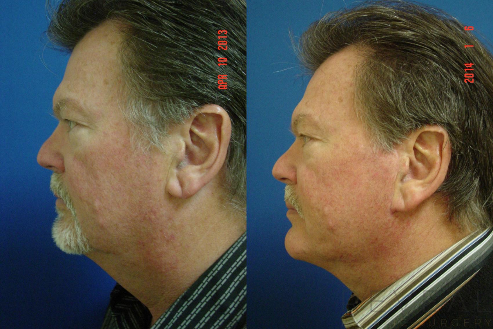 Before & After Facelift Case 123 View #1 View in San Jose, CA