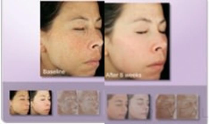 Before & After Skin Care Case 27 View #1 View in San Jose, CA