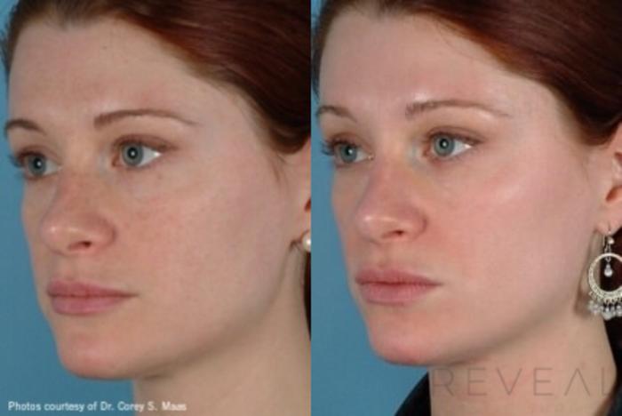 Before & After Skin Care Case 34 View #1 View in San Jose, CA
