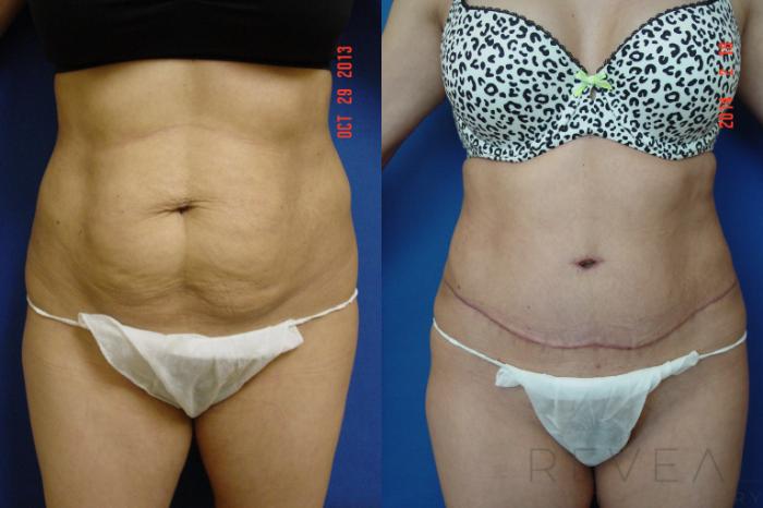 Before & After Tummy Tuck Case 130 View #1 View in San Jose, CA