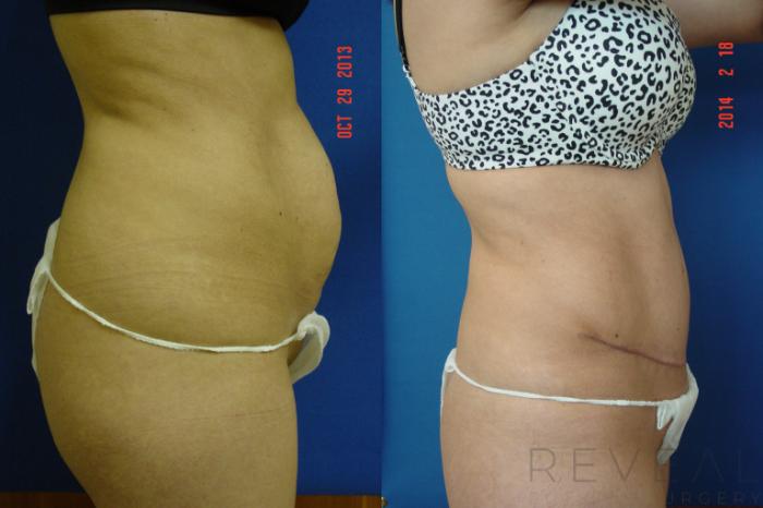 Before & After Tummy Tuck Case 130 View #4 View in San Jose, CA