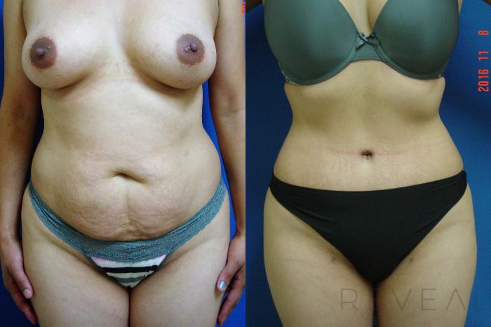 Before & After Brazilian Butt Lift Case 201 View #1 View in San Jose, CA