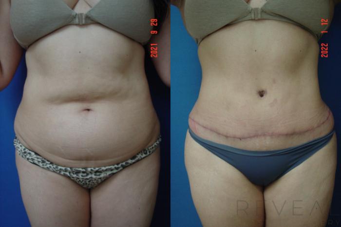 Before & After Tummy Tuck Case 609 Front View in San Jose, CA