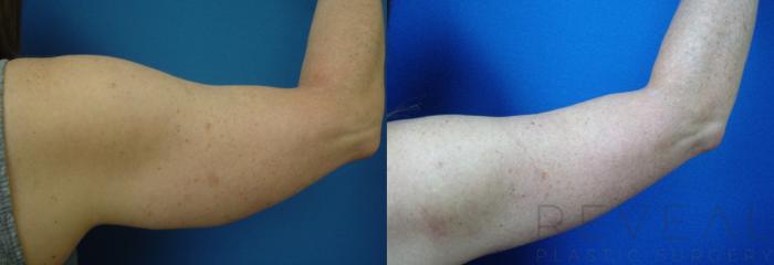Before & After Arm Lift Case 198 View #3 View in San Jose, CA