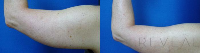 Before & After Arm Lift Case 198 View #4 View in San Jose, CA