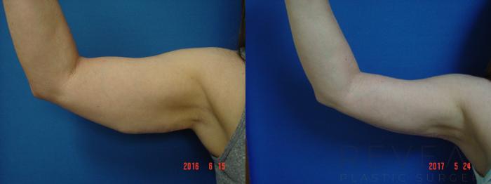 Before & After Arm Lift Case 218 View #1 View in San Jose, CA