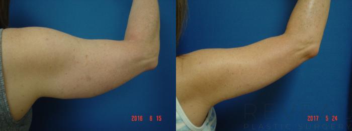 Before & After Arm Lift Case 218 View #4 View in San Jose, CA