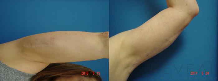 Before & After Arm Lift Case 218 View #5 View in San Jose, CA