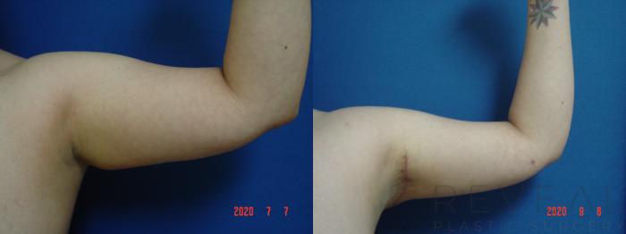 Before & After Arm Lift Case 424 View #1 View in San Jose, CA