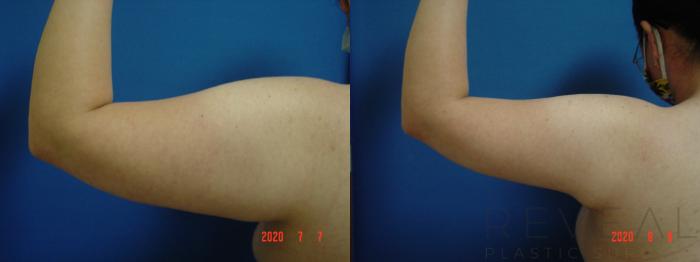 Before & After Arm Lift Case 424 View #3 View in San Jose, CA