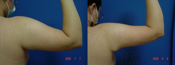 Before & After Arm Lift Case 424 View #4 View in San Jose, CA