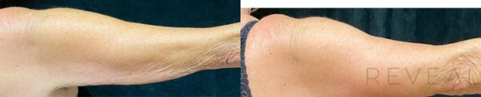 Before & After Arm Lift Case 496 View #2 View in San Jose, CA
