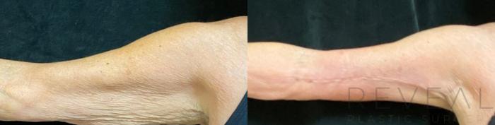 Before & After Arm Lift Case 496 View #3 View in San Jose, CA