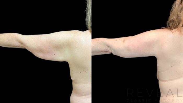 Before & After Arm Lift Case 770 Left Side View in San Jose, CA