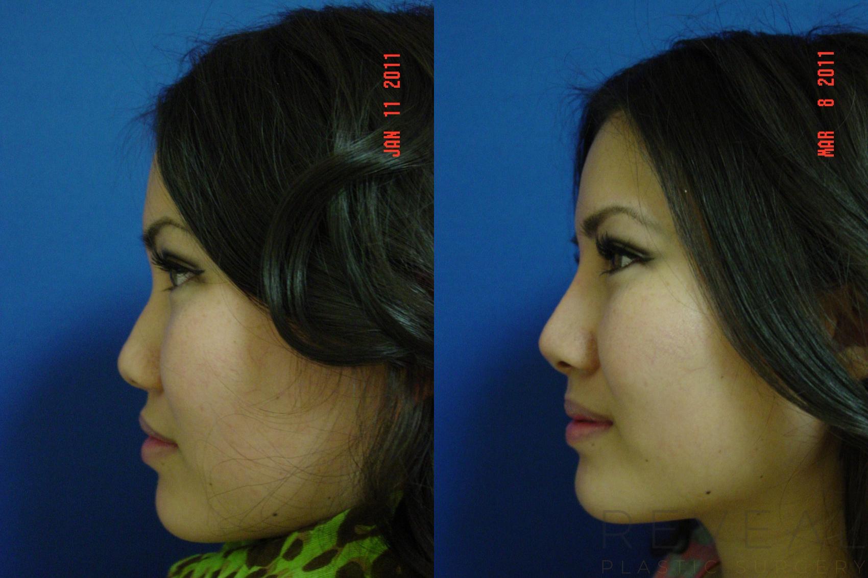 Before & After Rhinoplasty Case 55 View #1 View in San Jose, CA