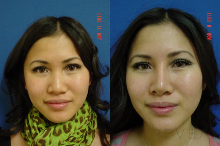 Before & After Rhinoplasty Case 55 View #2 View in San Jose, CA