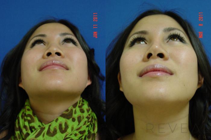Before & After Asian Rhinoplasty Case 55 View #3 View in San Jose, CA